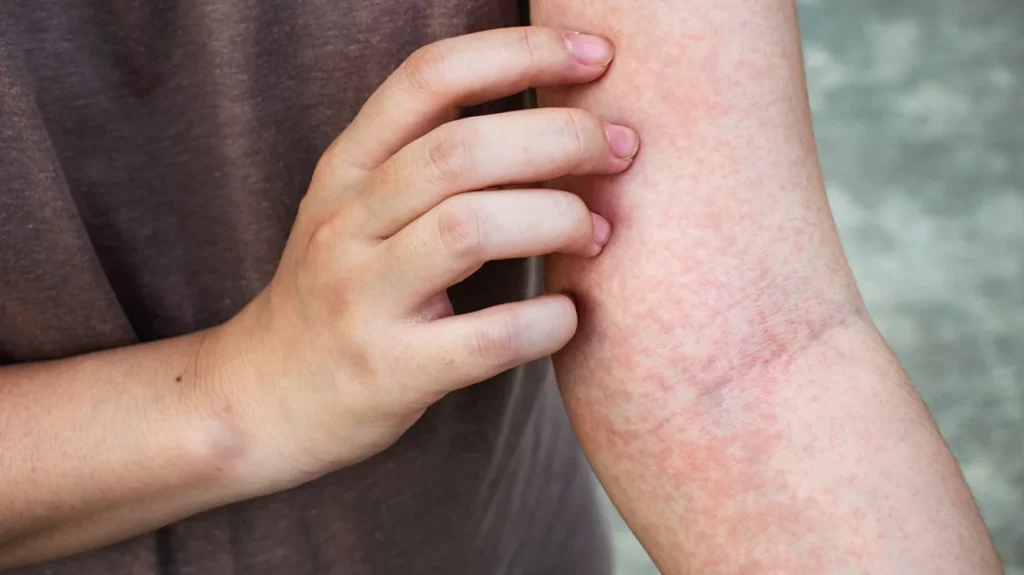 با انواع بیماری های پوستی خارش دار آشنا شوید؛ از پسوریازیس تا اگزما